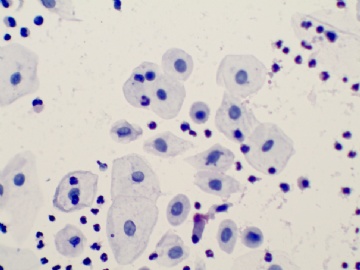 35岁妇女液基细胞学图12