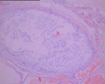 左足背肿瘤(免疫组化图像已上传）图18