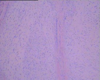 左足背肿瘤(免疫组化图像已上传）图42