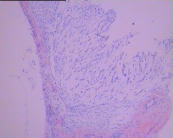 左足背肿瘤(免疫组化图像已上传）图47