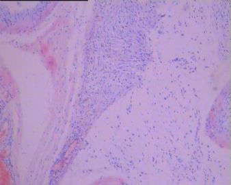 左足背肿瘤(免疫组化图像已上传）图48