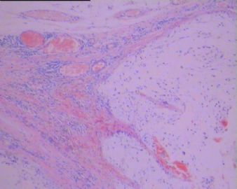 左足背肿瘤(免疫组化图像已上传）图49