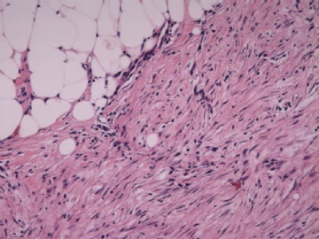 F63Y乳腺梭形细胞肿瘤图1