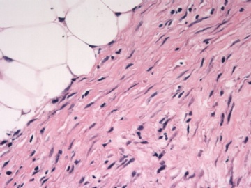 F63Y乳腺梭形细胞肿瘤图2