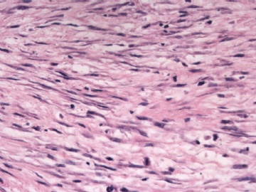 F63Y乳腺梭形细胞肿瘤图3