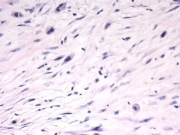 F63Y乳腺梭形细胞肿瘤图4