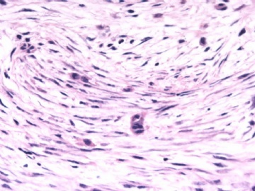 F63Y乳腺梭形细胞肿瘤图5