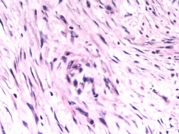 F63Y乳腺梭形细胞肿瘤图6