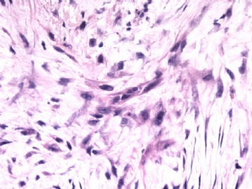 F63Y乳腺梭形细胞肿瘤图7