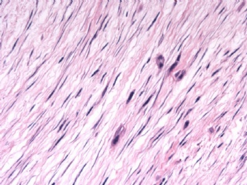 F63Y乳腺梭形细胞肿瘤图8