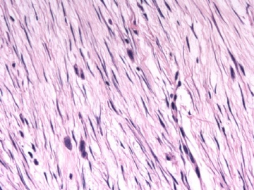 F63Y乳腺梭形细胞肿瘤图9