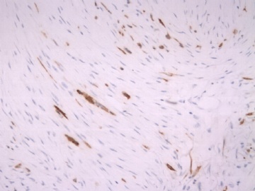 F63Y乳腺梭形细胞肿瘤图12