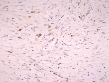 F63Y乳腺梭形细胞肿瘤图14