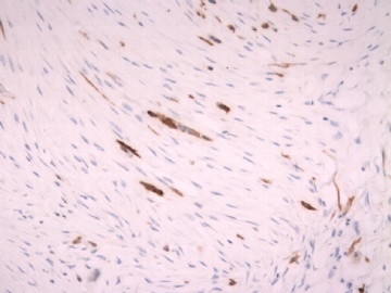 F63Y乳腺梭形细胞肿瘤图15