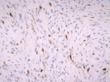 F63Y乳腺梭形细胞肿瘤图17