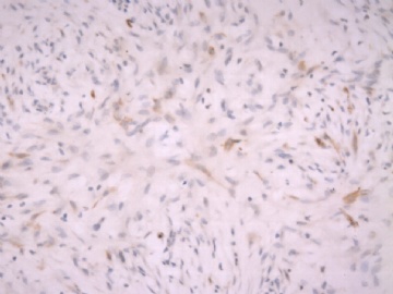 F63Y乳腺梭形细胞肿瘤图20