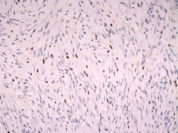 F63Y乳腺梭形细胞肿瘤图22