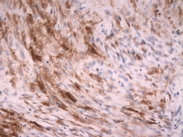 F63Y乳腺梭形细胞肿瘤图23