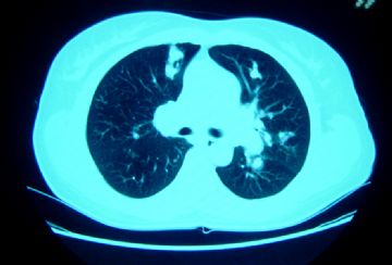 肺肿物图4