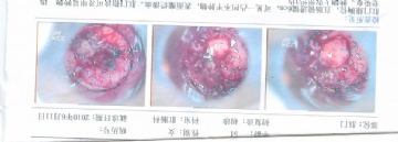 再麻烦请教：重发一张同一病人的切片（直肠隆起物）图2