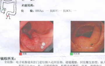 再麻烦请教：重发一张同一病人的切片（直肠隆起物）图3