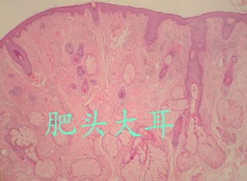 临床典型结节性硬化，病理如何出比较贴切图1