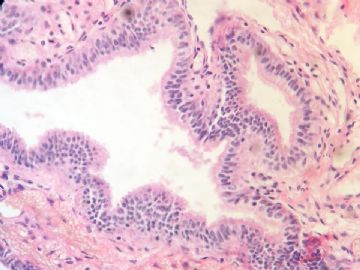 卵巢：囊腺瘤协助分级图5