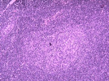 淋巴结梭形细胞肿瘤（20103206）图3