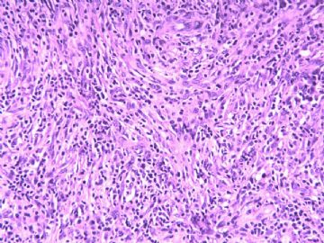 淋巴结梭形细胞肿瘤（20103206）图7