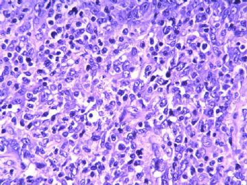 淋巴结梭形细胞肿瘤（20103206）图8