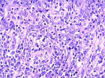 淋巴结梭形细胞肿瘤（20103206）图9