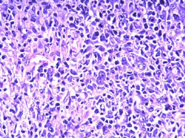 淋巴结梭形细胞肿瘤（20103206）图11