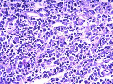 淋巴结梭形细胞肿瘤（20103206）图12