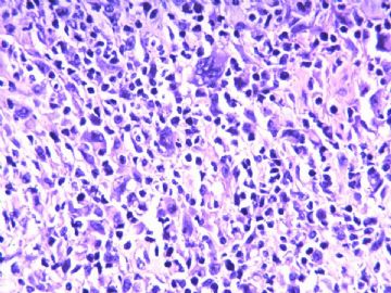 淋巴结梭形细胞肿瘤（20103206）图13