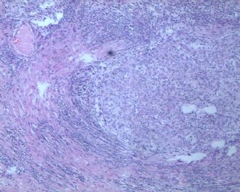 右侧卵巢肿瘤图3