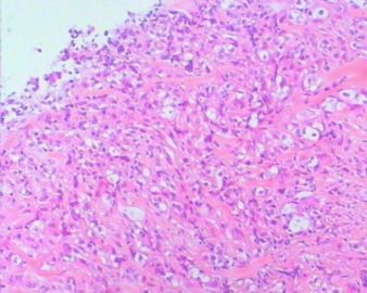 为配合abin的讲座特发几个乳癌新辅助化疗病例---病例1图4