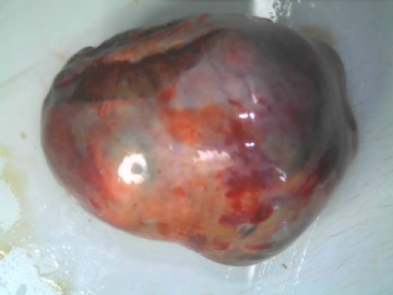 卵巢瘤冰冻图1