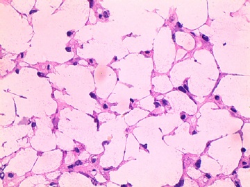 卵巢瘤冰冻图15