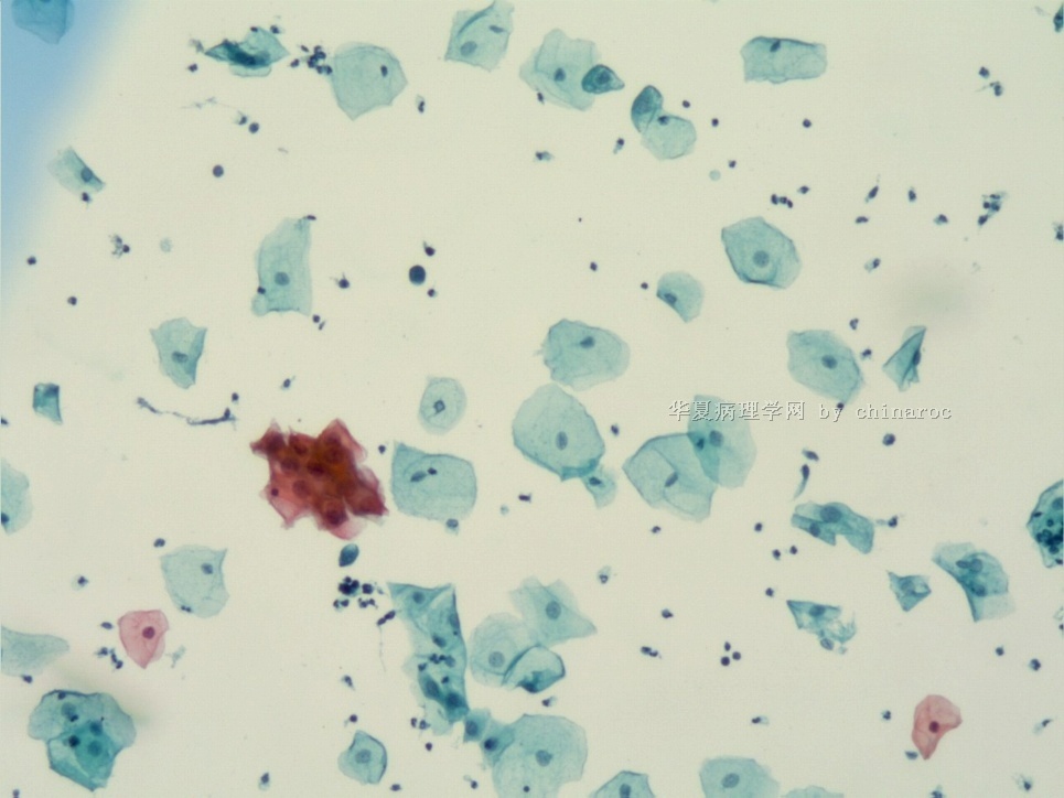 宫颈液基细胞学-地坛9图2