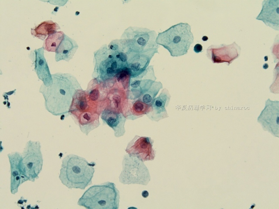宫颈液基细胞学-地坛9图3
