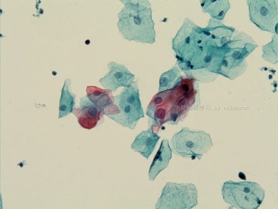 宫颈液基细胞学-地坛9图4