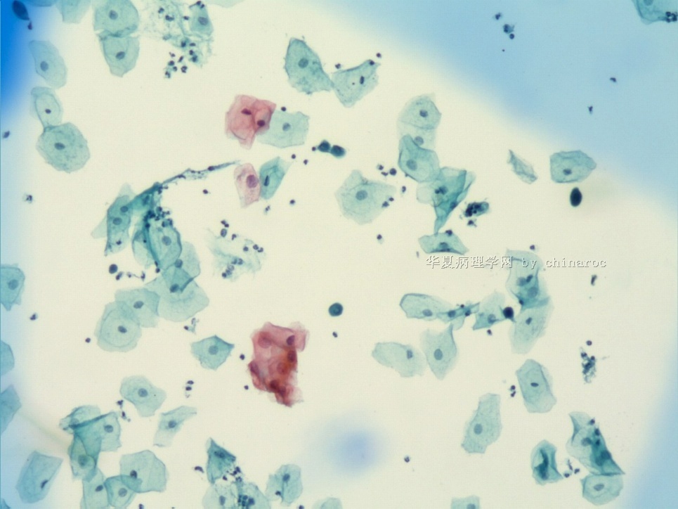 宫颈液基细胞学-地坛9图5
