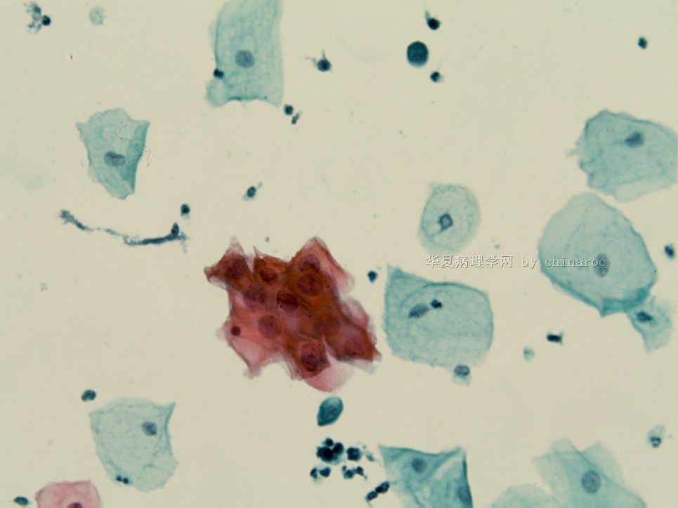 宫颈液基细胞学-地坛9图6