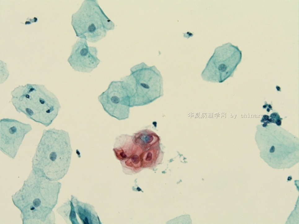 宫颈液基细胞学-地坛9图7