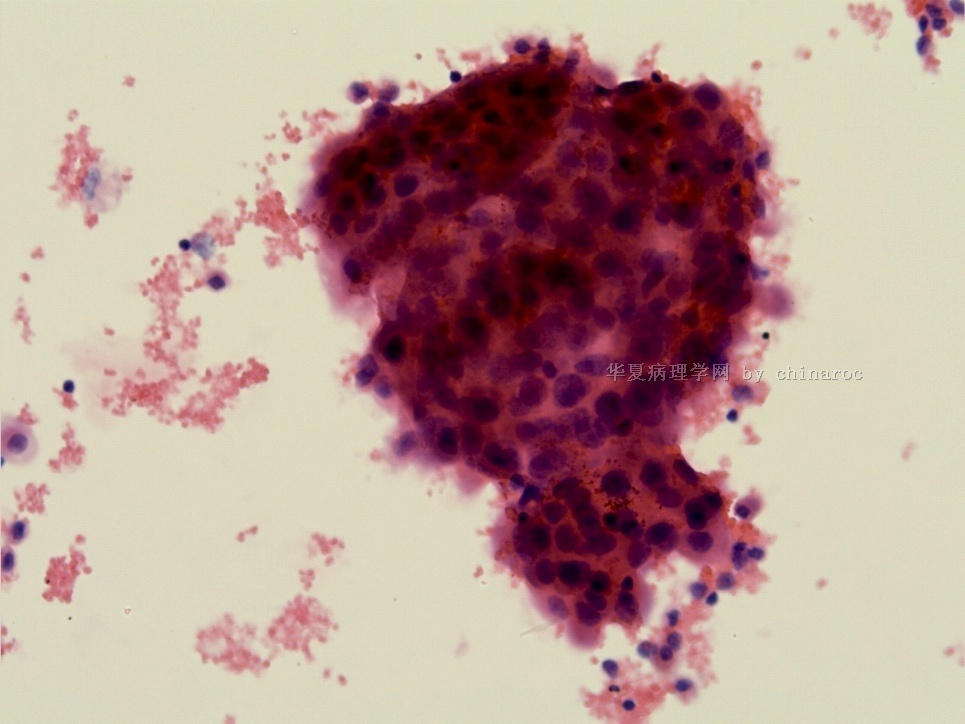 胸水液基细胞学-地坛图6