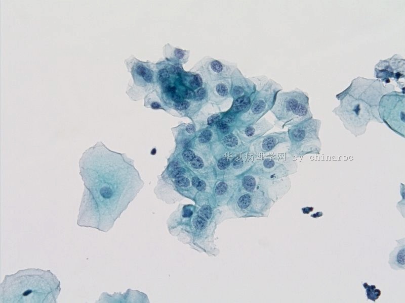 宫颈液基细胞学-地坛10图6
