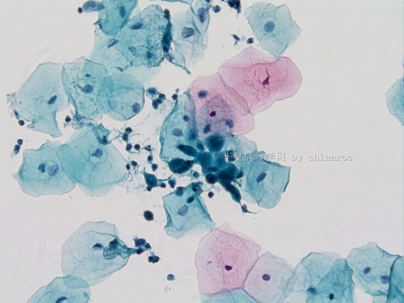 宫颈液基细胞学-地坛10图8