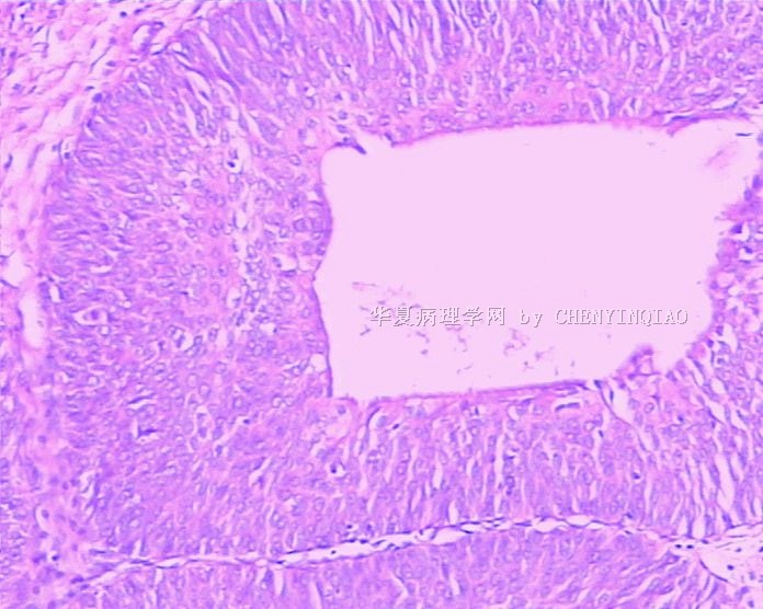 膀胱新生物图4