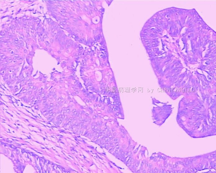 膀胱新生物图8