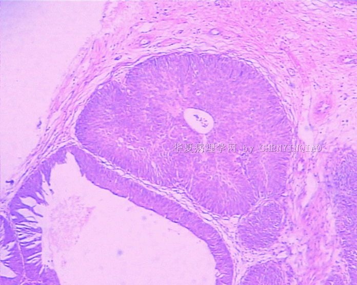 膀胱新生物图9